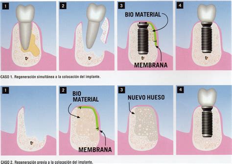 Implantes Dentales – Clínica Dental Fene Ana Mª Silva y Johnny Tajes