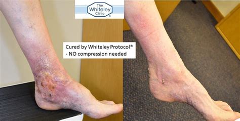 Venous leg ulcer cured without compression – The Whiteley Clinic