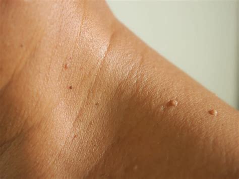 What Can I Do to Help My Skin Tags? - Arlington Dermatology