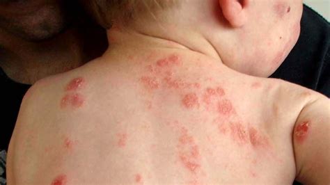 Scientists scratch an itch and make a breakthrough in eczema research - ABC listen