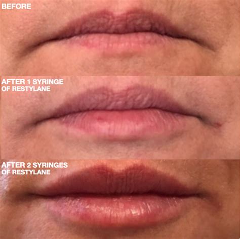 Restylane Lip Filler After Care - Check spelling or type a new query.