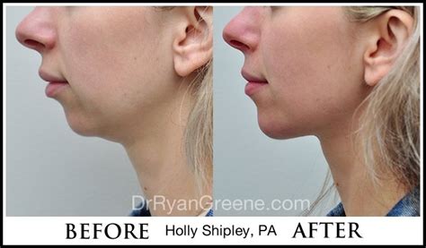 Chin augmentation and profile enhancement with Juvederm Voluma. Non ...