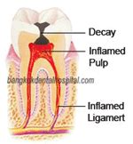 Root Canal: Open Root Canal Infection