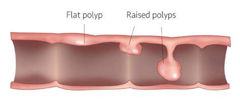 Flat polyps: Why finding them requires skill | UCI Health | Orange County, CA