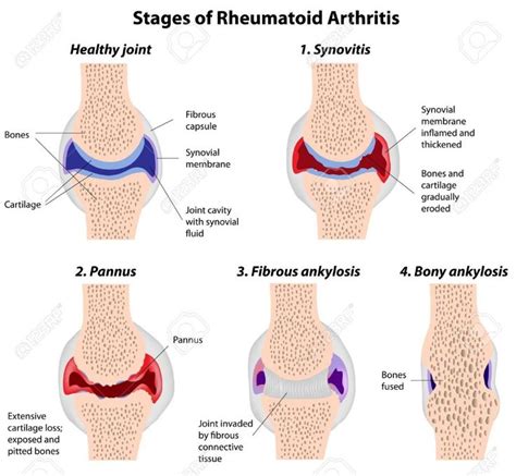 Stages Of Rheumatoid Arthritis Check more at http://www.nhprimecare.org/stages-of-rheumatoid ...