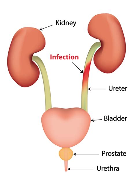 Urinary Tract Infection In Women - Complicated Latest News And CME | MIMS Singapore