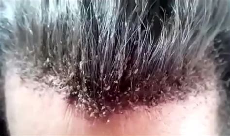Head full of lice is the weirdest video you will ever see! | Buzz News, India.com