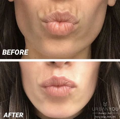 Upper Lip Botox Before And After