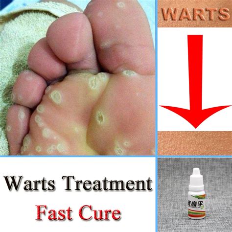 Chinese Medicine Treatment Foot Corn Removal Plantar warts Pomada De ...