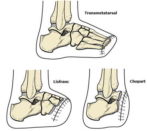 Amputation causes, types of amputation and amputation complications