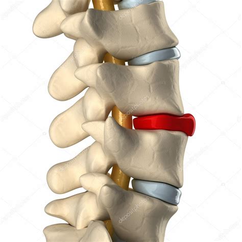 Ruptured disc in lateral view — Stock Photo © CLIPAREA #13282896