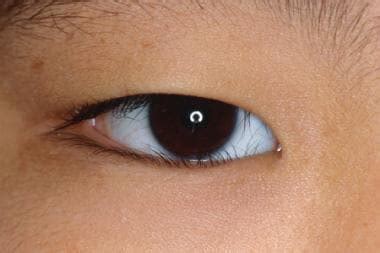 Trichiasis