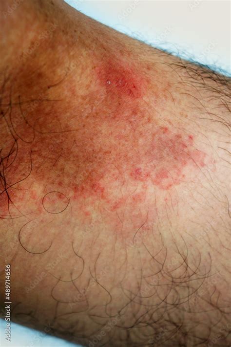 Itchy rash in the groin area. Tinea Cruris is a type of skin disease ...