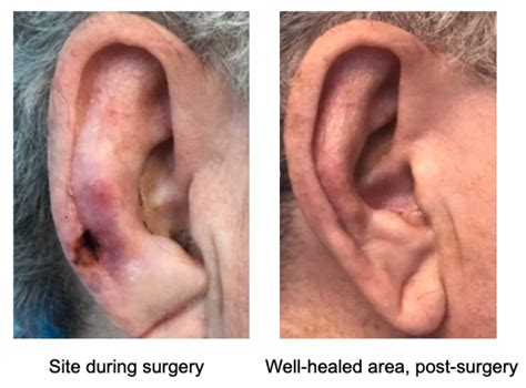 Basal cell carcinoma on the ear | Mclean VA & Woodbridge, VA | Skin ...