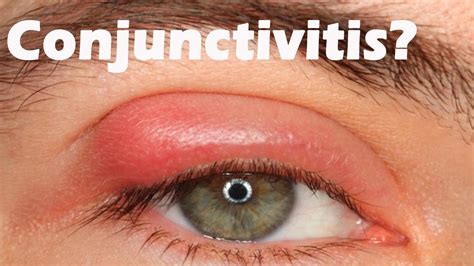 Understanding the Three Kinds of Conjunctivitis: Causes and Symptoms - Pilates & Yoga Fitness