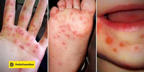 Hand-foot-and-mouth disease in 30 Iloilo towns | Daily Guardian