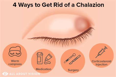 Chalazion Eyelid Cyst Causes Symptoms Treatments - vrogue.co