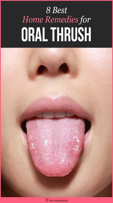 Home Remedies for Oral Thrush Here are some best natural remedies that ...