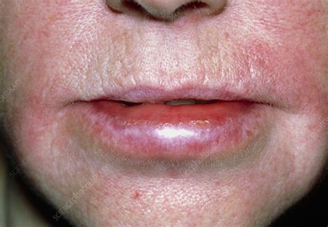 Angioedema Lips Pictures | Lipstutorial.org