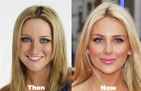 Stephanie Pratt Plastic Surgery Before and After Photos