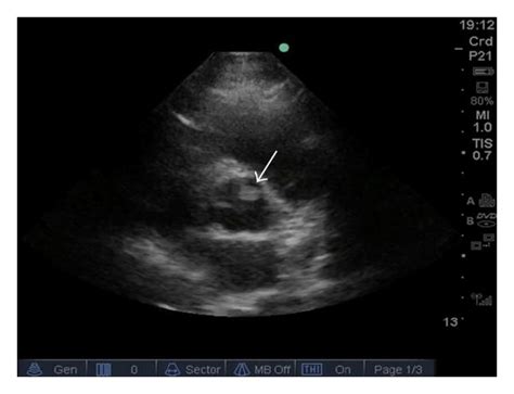 MRI image showing that there is a 1.3 cm pedunculated mass that arises... | Download Scientific ...