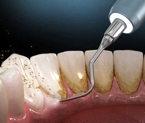 How To Remove Plaque From Teeth - Life Dental