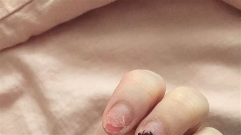 Beauty Blogger Shares Effects of Acrylic Nails on Instagram | Teen Vogue