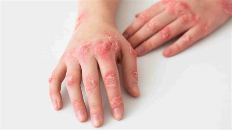 Common Skin Conditions Eczema, Dermatitis & Psoriasis Guide