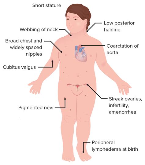 Monosomy Turner Syndrome