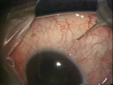 Avastin Eye Injection : Side Effects Of Avastin Injections In The Eye - creditosgrazy