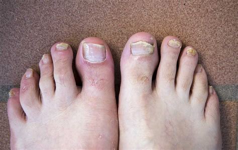 What Should I Do If My Nails Are Fungal? – Care For Feet | atelier-yuwa.ciao.jp