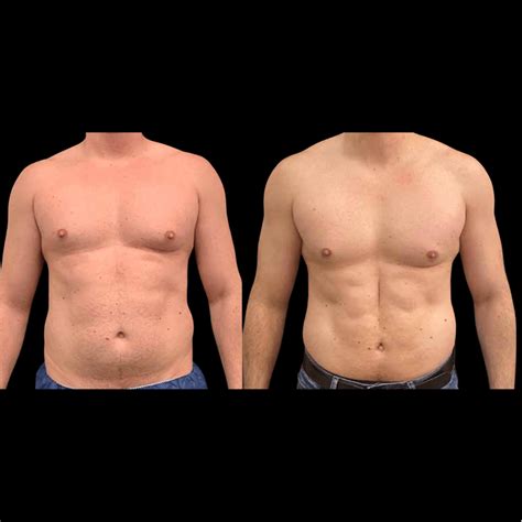 Before & After: Male Liposuction Results - Neinstein Plastic Surgery