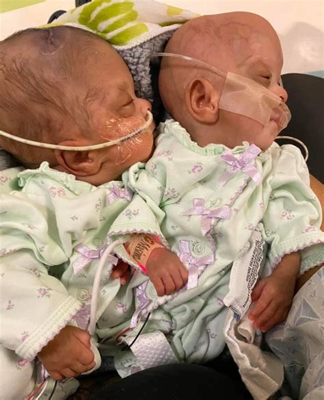 Astonishing Photos Show Birth Of Second Most Premature Twins Ever To | Free Download Nude Photo ...