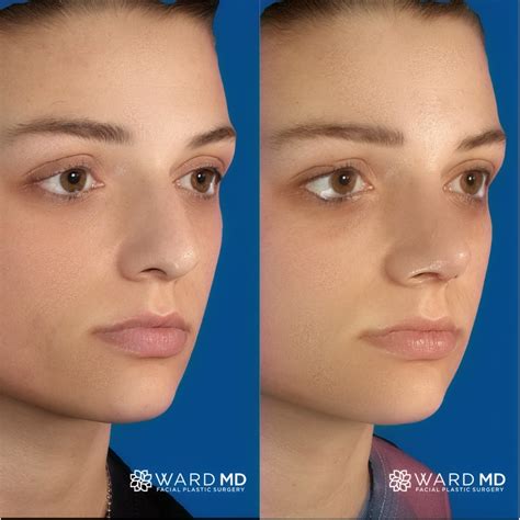 Ward MD Rhinoplasty Before & After Doesn't this patient's new nose compliment her facial ...