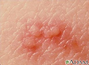 Shingles: MedlinePlus Medical Encyclopedia