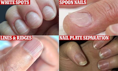 Experts reveal common nail problems and what these say about health ...