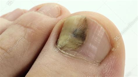 Infected Toe