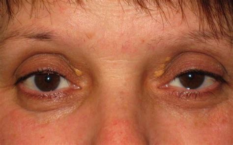 Xanthelasma | Yellow Cholesterol Patches Around Eyes Treatment | Mr ...