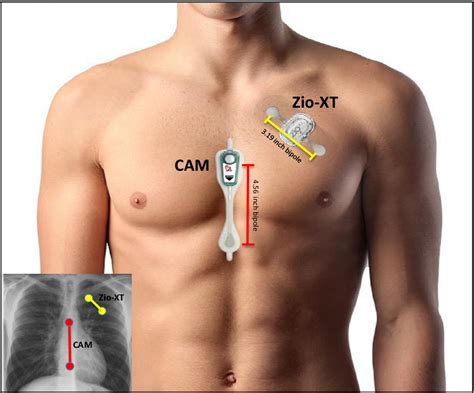 Figure 2 from Comparison of 2 ambulatory patch ECG monitors: The ...