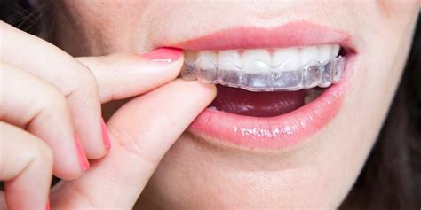 Invisalign Buck Teeth - San Antonio Orthodontics | Invisalign Clear Braces