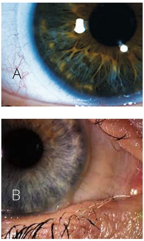 The Science of Fitting Soft Contact Lenses - Eyedolatry