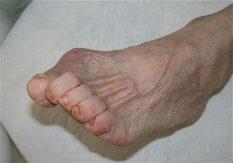 Causes of diabetic foot lesions - The Lancet