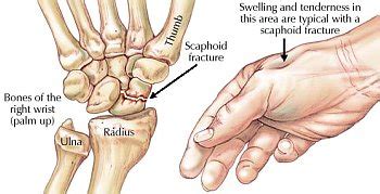 Scaphoid Fracture Surgery | Diagnosis, procedure & recovery | SportsMD