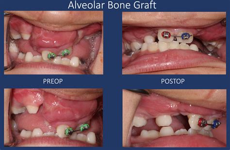 Alveolar Bone Graft