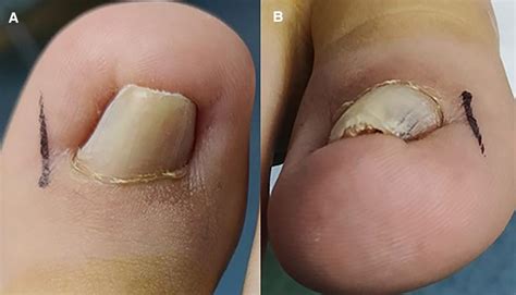 Frontiers | Reconstruction of a nail bed with double-layer artificial dermis for a pincer nail ...