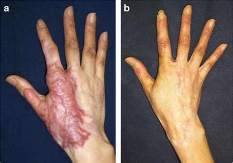 Surgery for scar revision and reduction: from primary closure to flap surgery | Burns & Trauma ...