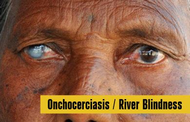 Onchocerciasis River Blindness Microscopic Nematode