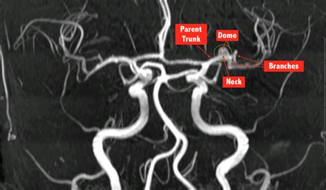 6. MRI-A COW Left MCA aneurysm | C.N.S. Neurosurgery