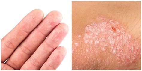 Eczema or Psoriasis: What’s the Difference? | Genesis Dermatology