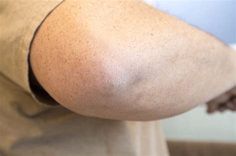 How to Get Rid of Dark, Rough Elbows | Livestrong.com